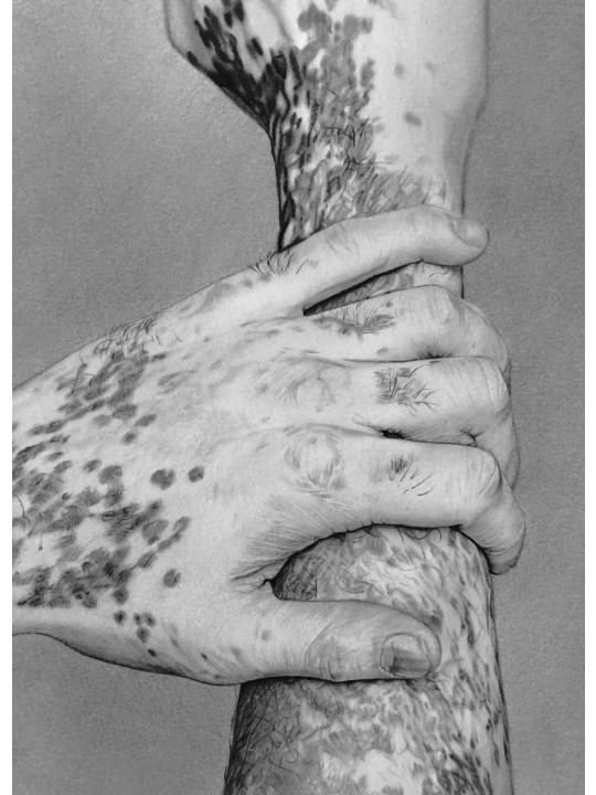 Vitiligo