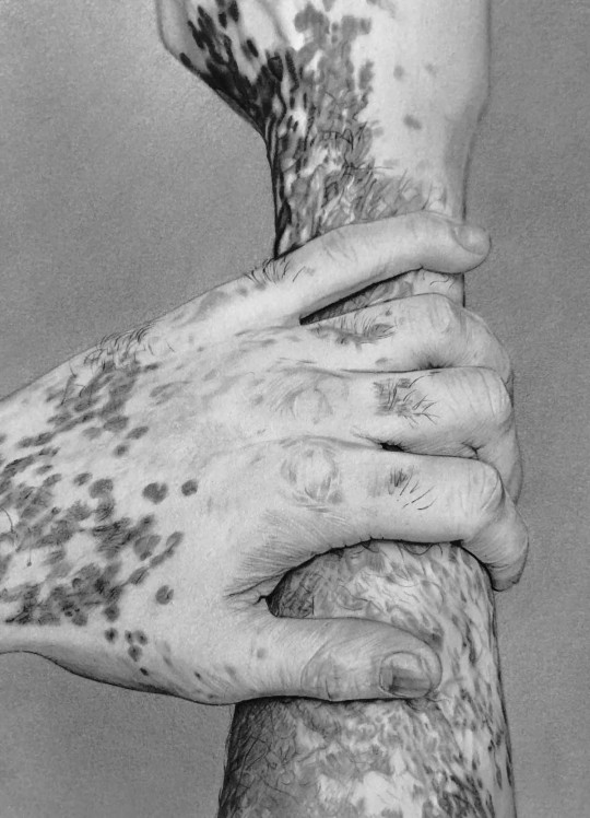 Vitiligo