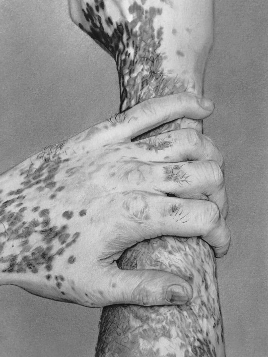 Vitiligo